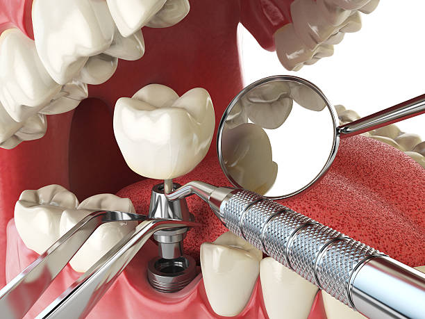 Best Emergency Tooth Extraction in Meeker, OK